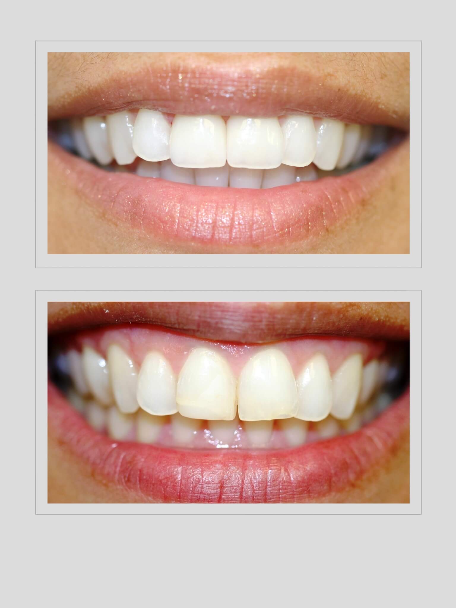 Failing Bondings Before and After Dental Treatment