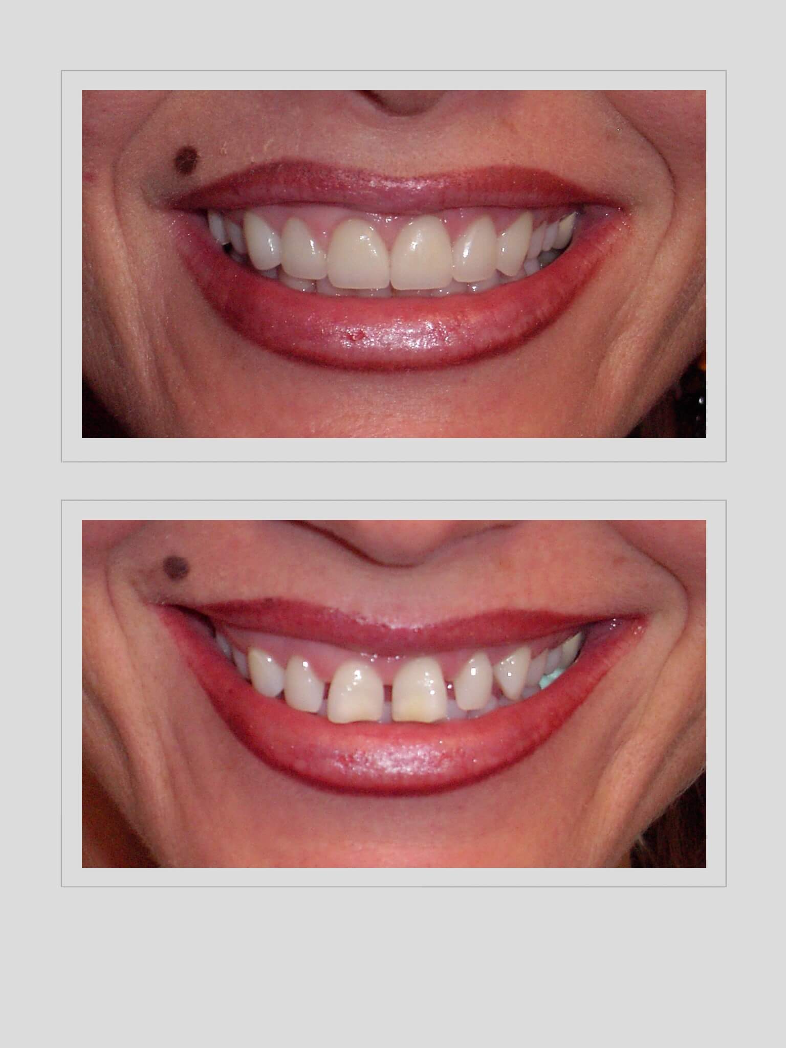 Restorative Dental Treatment to Correct