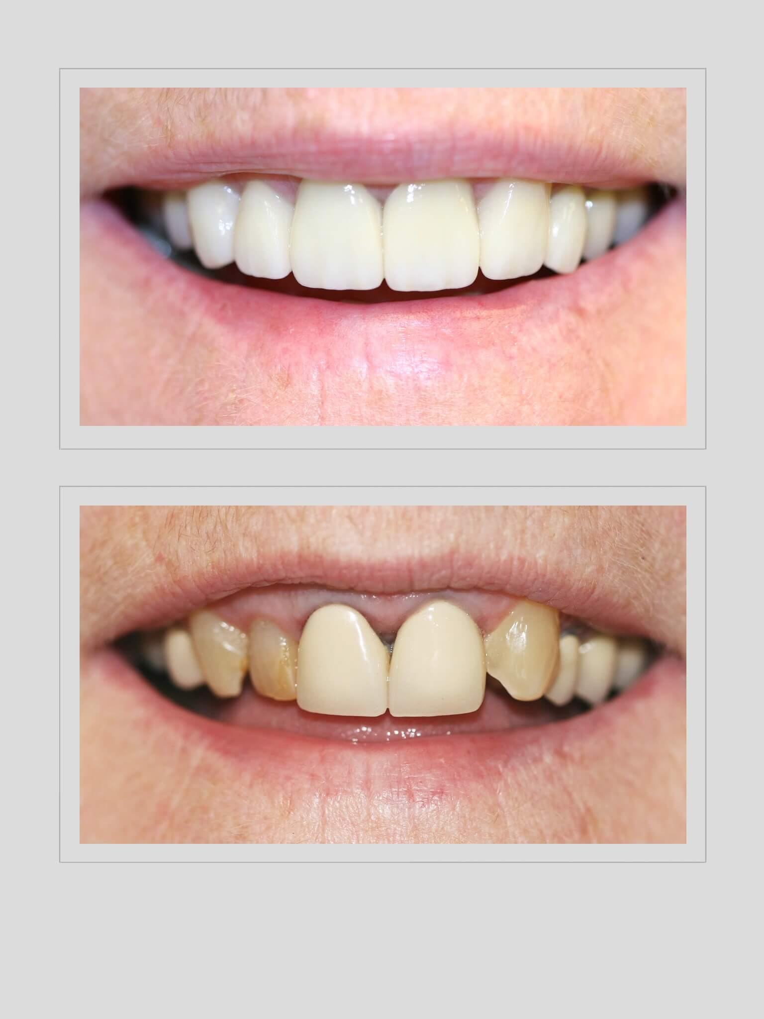 Ocean Hills Dentistry - Smile Gallery Before and After Image of Old Restorations causing an Allergic Reaction