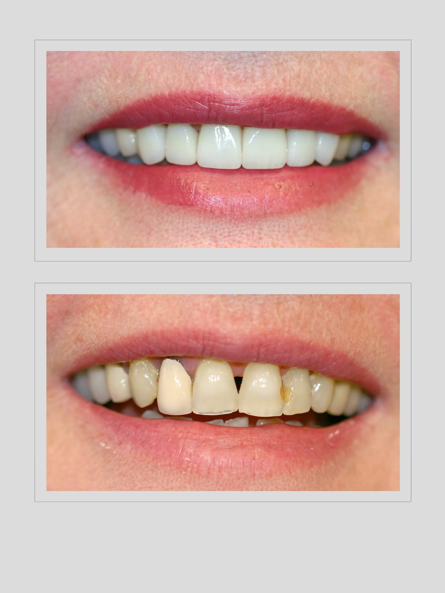 Ocean Hills Dentistry - Smile Gallery Before and After Image of Asymmetric Smile/Old Restorations