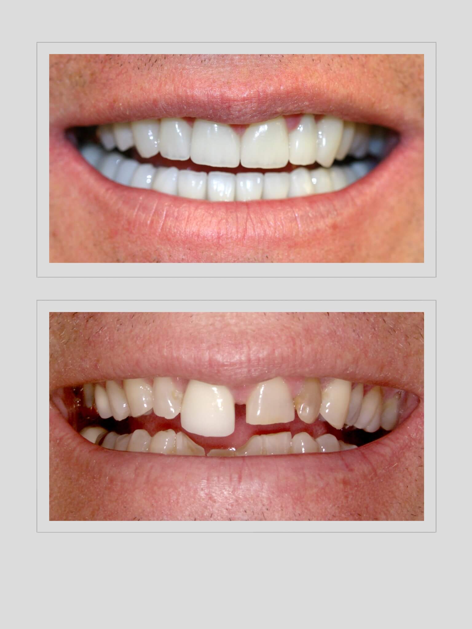 Ocean Hills Dentistry - Smile Gallery Before and After Image of Neglected Dentition
