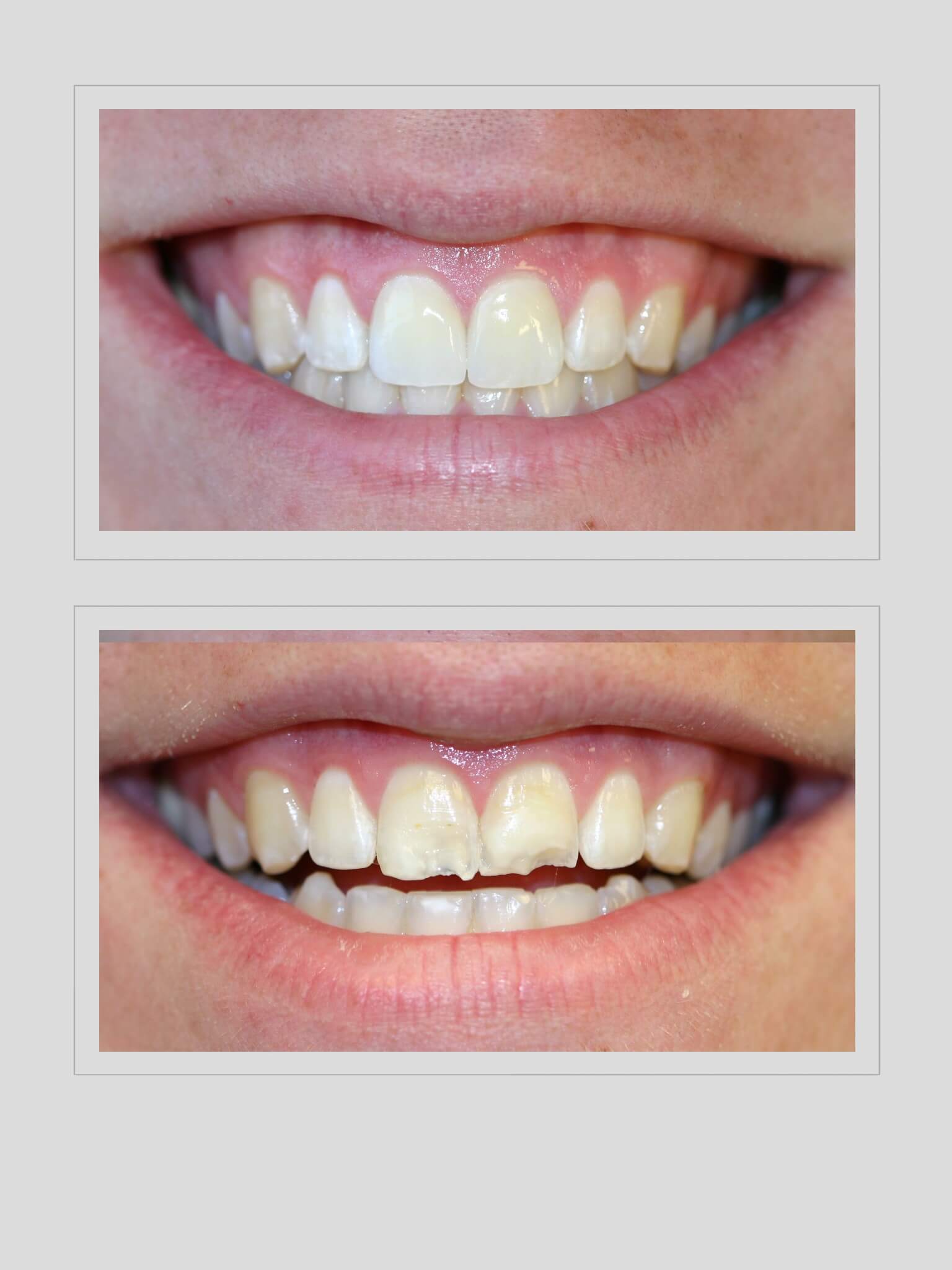 Ocean Hills Dentistry - Smile Gallery Before and After Image of Fractured Teeth due to Trauma/Accident