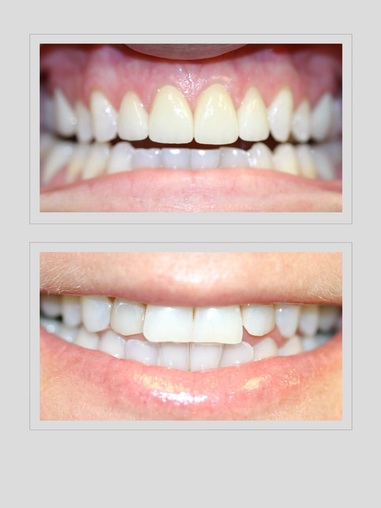 Ocean Hills Dentistry - Smile Gallery Before and After Image of Tooth size discrepancy after Orthodontic Treatment