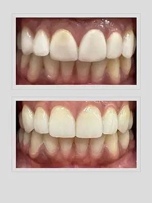 Insights Before and After Image of Smile Revision by Ocean Hills Dentistry